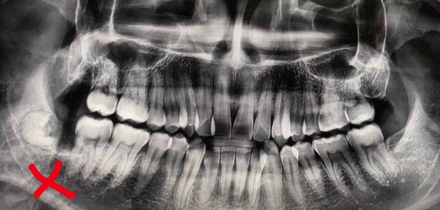牙医的温柔之微创拔牙，用专业细致“搞定”疑难阻生牙（上）