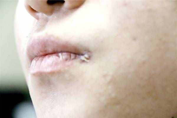 为什么嘴角总是频繁起泡？可能是哪些疾病引起的？如何改善？