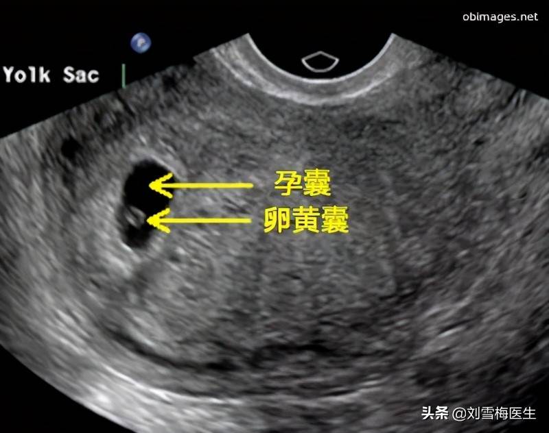 孕囊、胎芽长到这个值仍未见胎心，提示胚胎停止发育