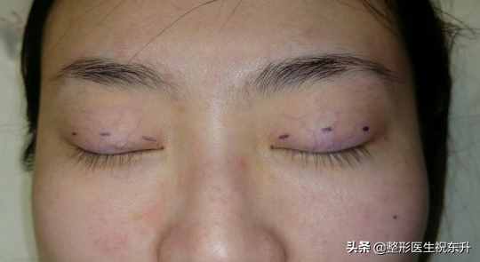 三点定位双眼皮手术（什么是三点式双眼皮？有什么特点？）