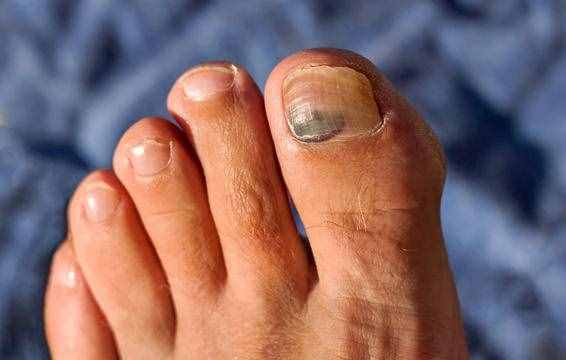 皮肤科医生：脚趾甲变厚，是什么原因？