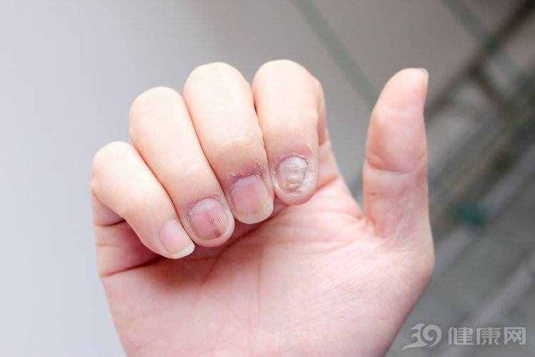 指甲符合3个特点，你染上灰指甲了！医生：这些治疗方法收着备用