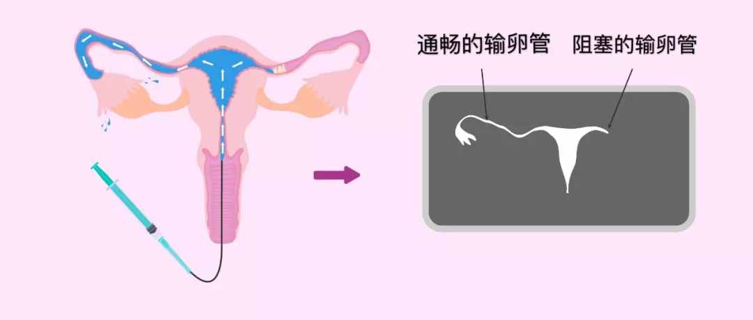 输卵管造影过程（输卵管造影的5个步骤）