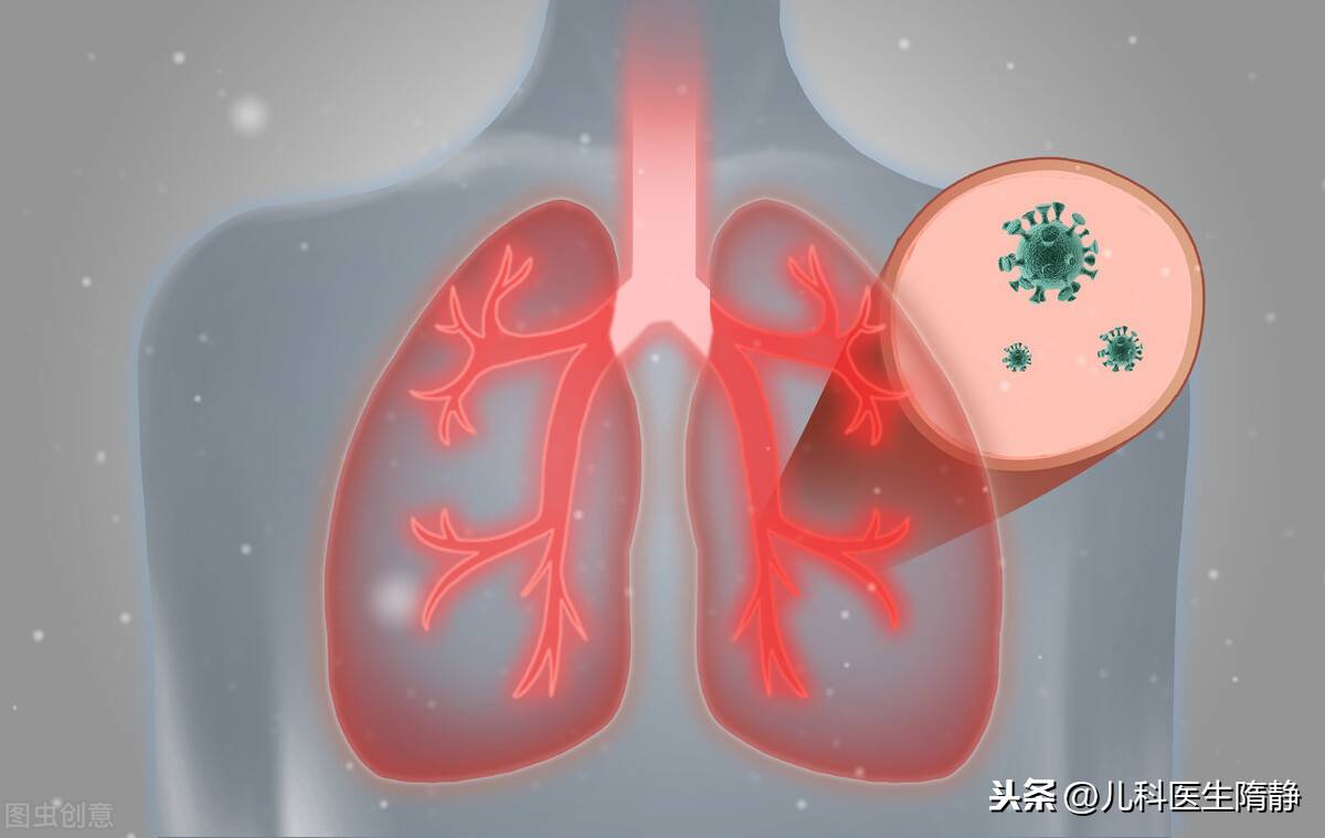 支气管肺炎-儿童最常见的肺炎，您了解吗？