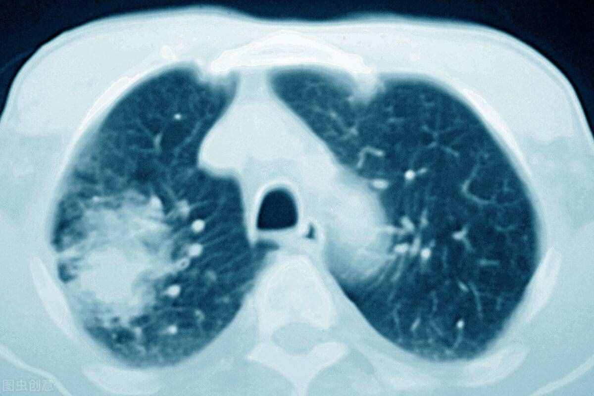 肺癌饮食（肺癌患者饮食怎么吃）