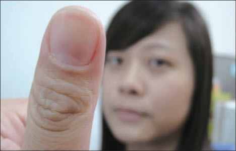 灰指甲早期症状图片（如何判断灰指甲）