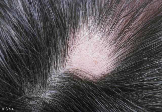头发斑秃的原因（导致斑秃的罪魁祸首或是这6个）