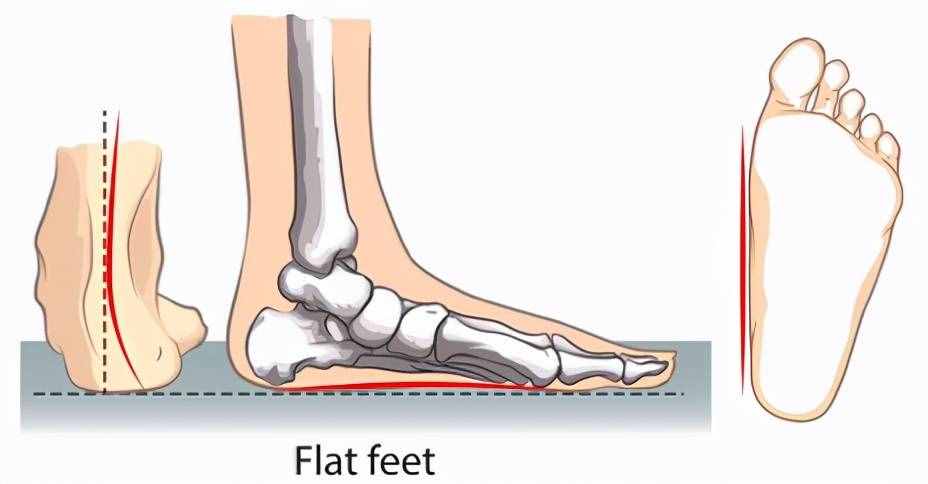 扁平足——有一种痛叫做“脚踏实地”的痛