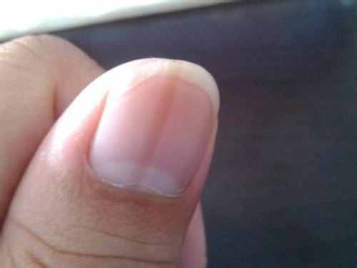 指甲有竖纹，是身体的什么信号？