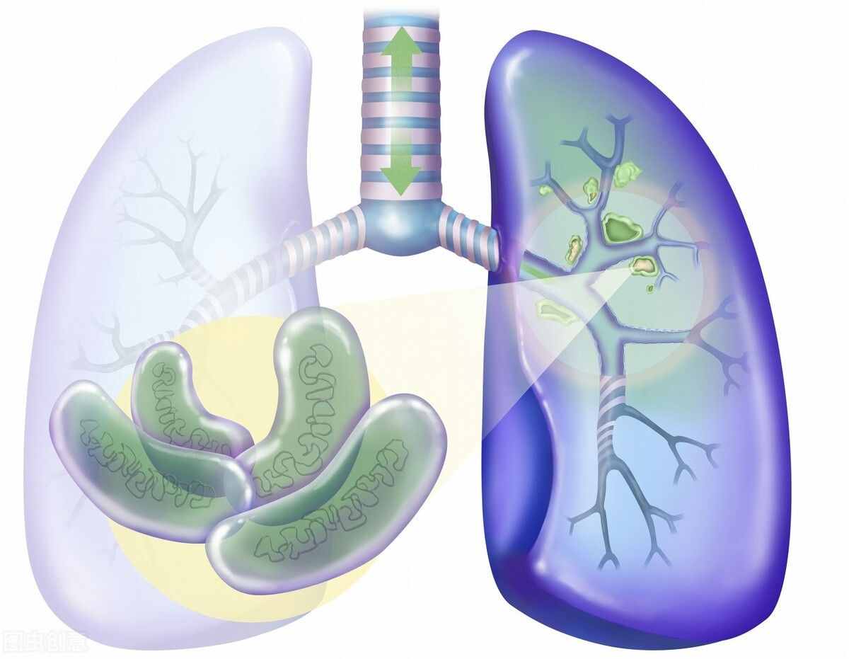 肺结核的症状（肺结节的症状表现有哪些?）