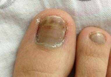 成都康华医院灰指甲医师：灰指甲有传染性，2个民间偏方搞定它！