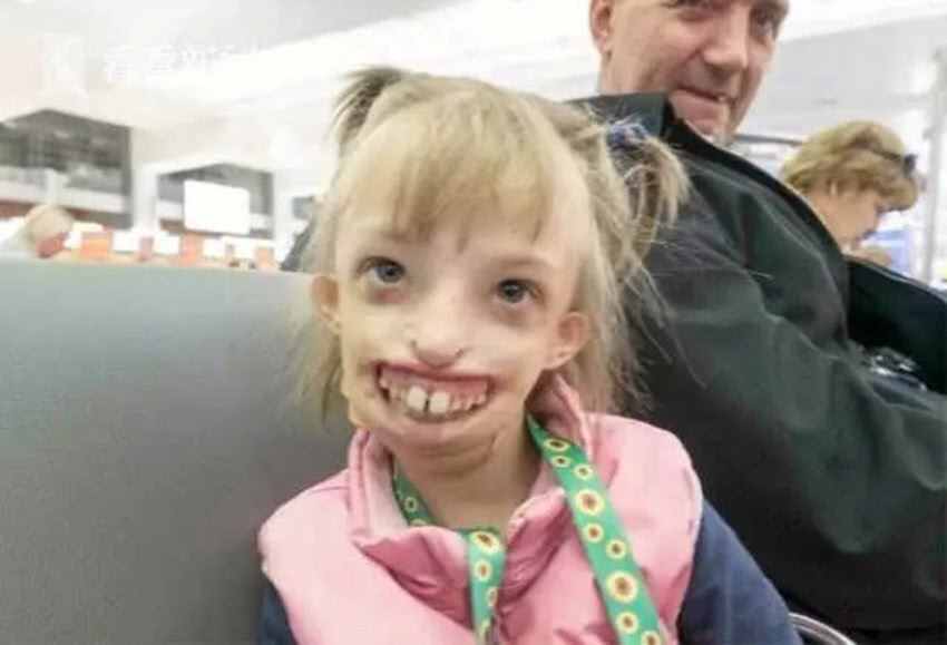 俄罗斯女童没有嘴唇和下巴，面容让人惊惧，经过手术终于展开笑颜