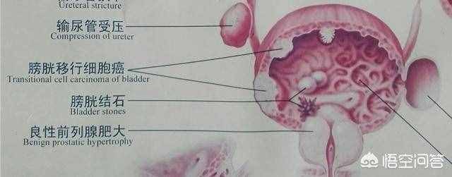 膀胱癌能活多久（膀胱癌一般寿命多长？）