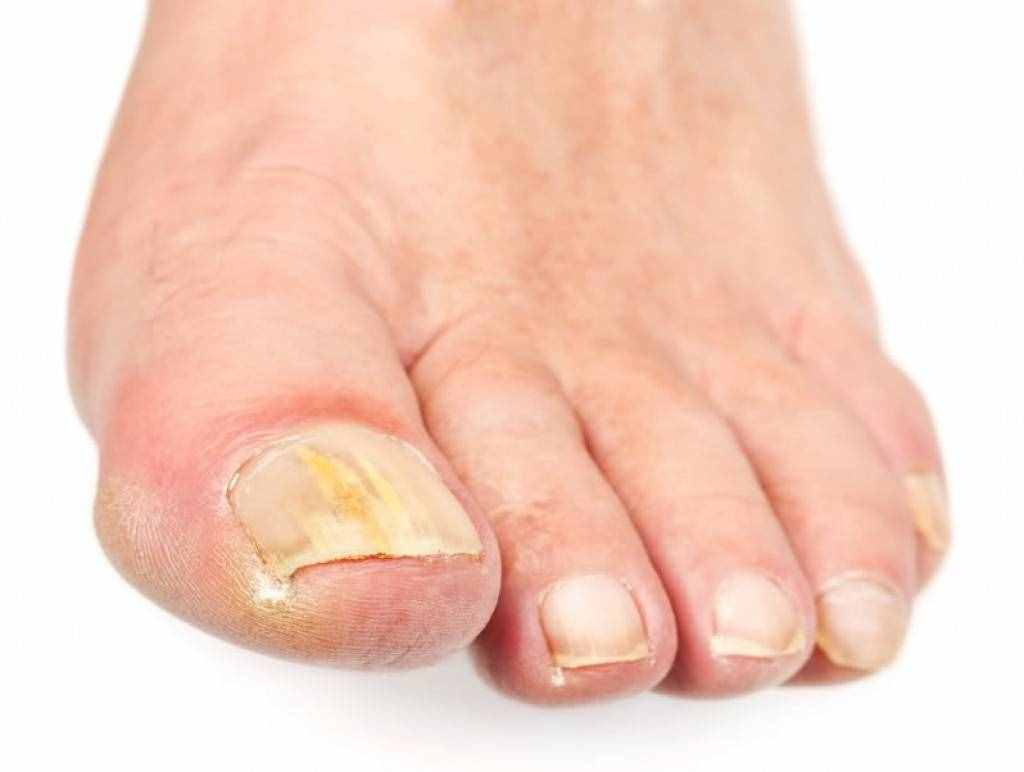 皮肤科医生：脚趾甲变厚，是什么原因？