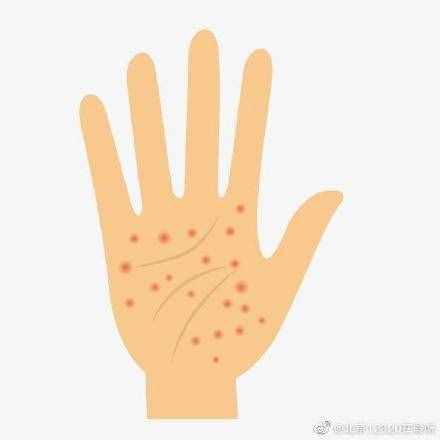 手部湿疹是什么？