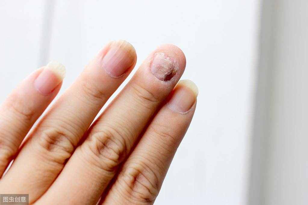 指甲符合3个特点，你染上灰指甲了！医生：这些治疗方法收着备用