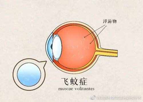 什么是近视性飞蚊症